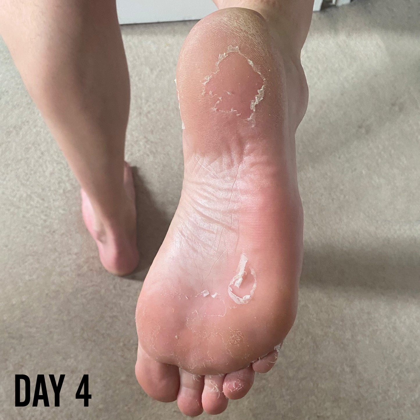 FOOT PEEL