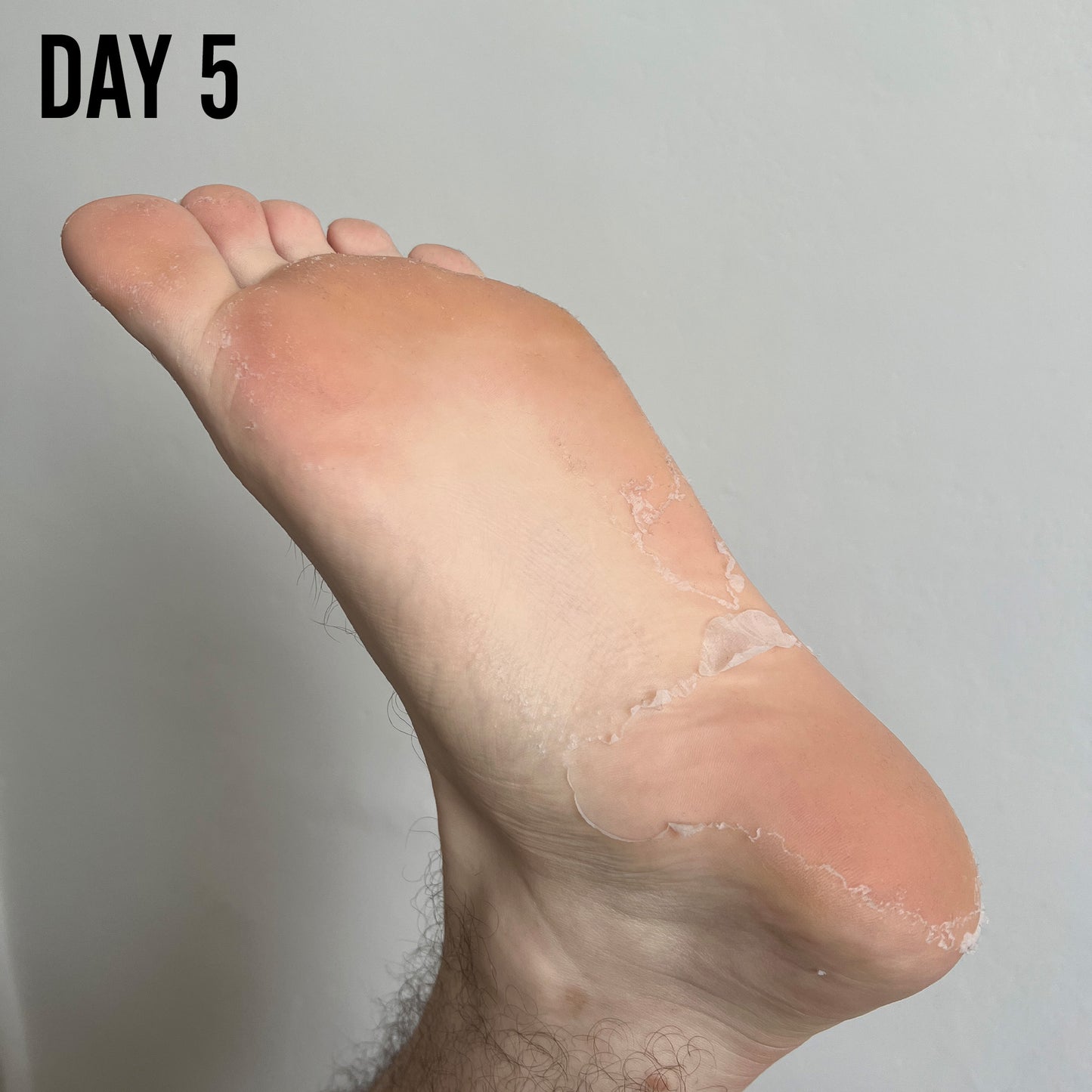FOOT PEEL